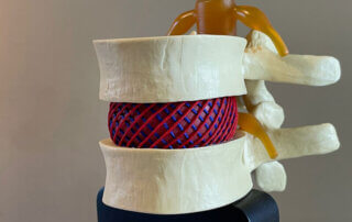 modelo de hernia lumbar conn fibras cruzadas del disco intervertebral